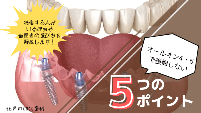 オールオン4・6で後悔しないための5つのポイントを徹底解説