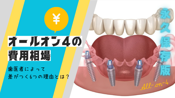 オールオン4の費用相場！歯医者で治療費が異なる6つの理由を歯科医師が解説