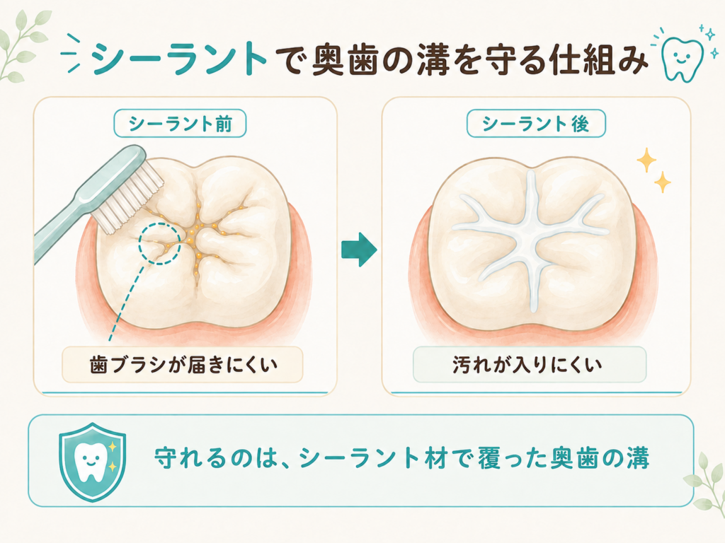 シーラント前後の奥歯を比較し、歯ブラシが届きにくい溝をシーラント材で覆う仕組みを示した図