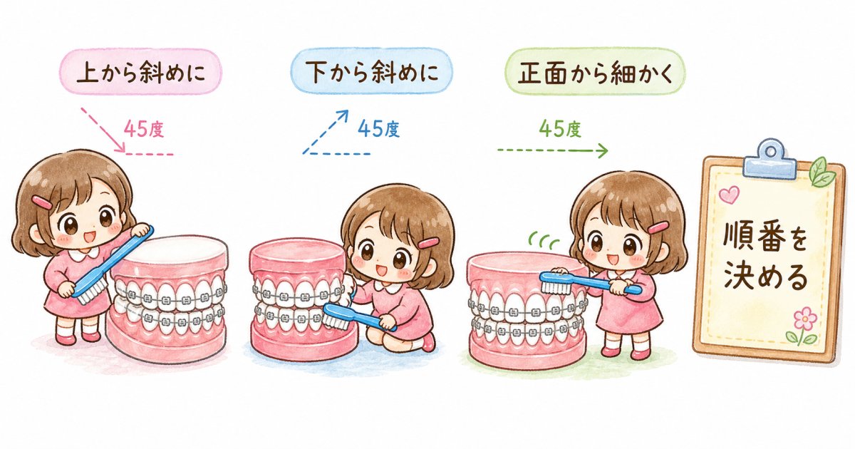 ワイヤー矯正中にむし歯・歯肉炎リスクが高まる理由と汚れやすい部位