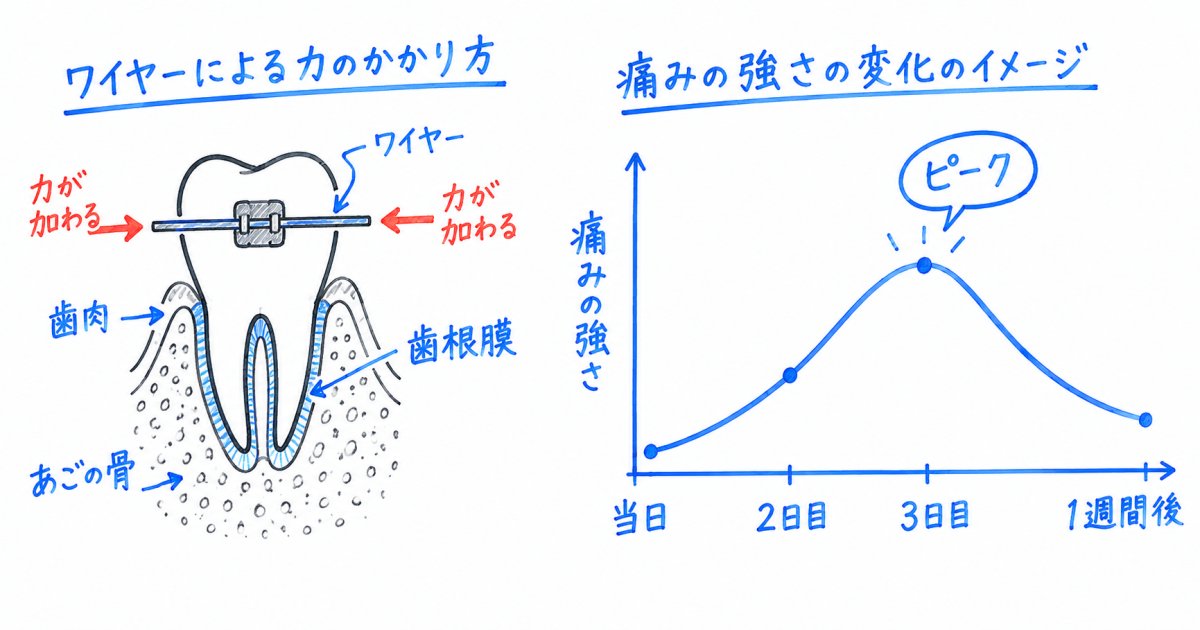 ワイヤー矯正の痛みはなぜ起こる？装着後・調整後の経過目安