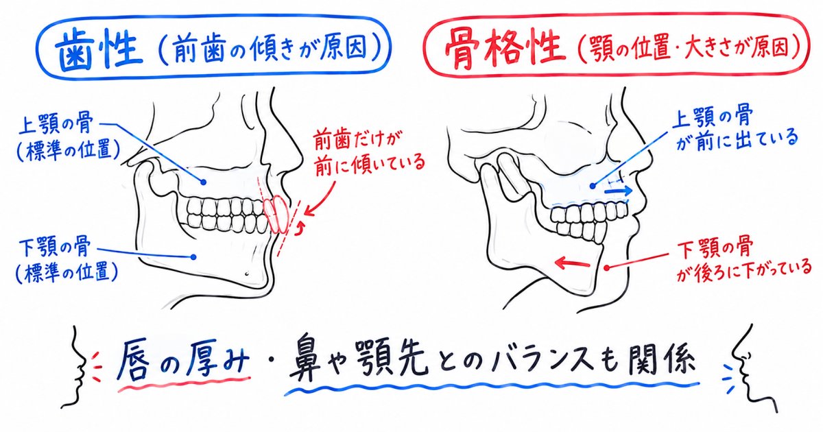 横顔がゴボ口に見える出っ歯は、歯の傾きと顎の骨格のどちらが原因?