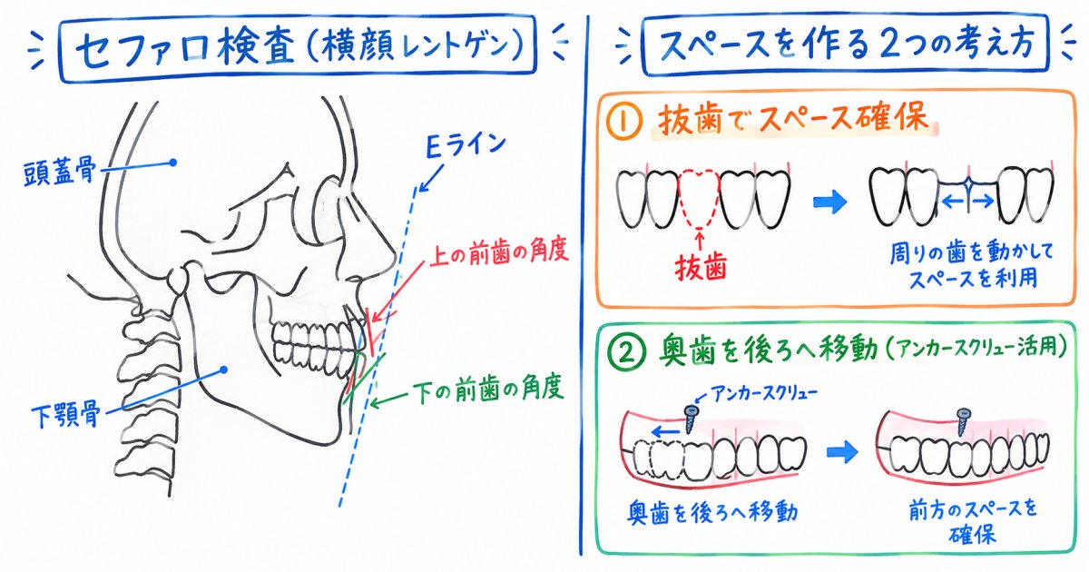 歯科のセファロ検査で何がわかり、原因によって矯正方針や抜歯の考え方はどう変わる?